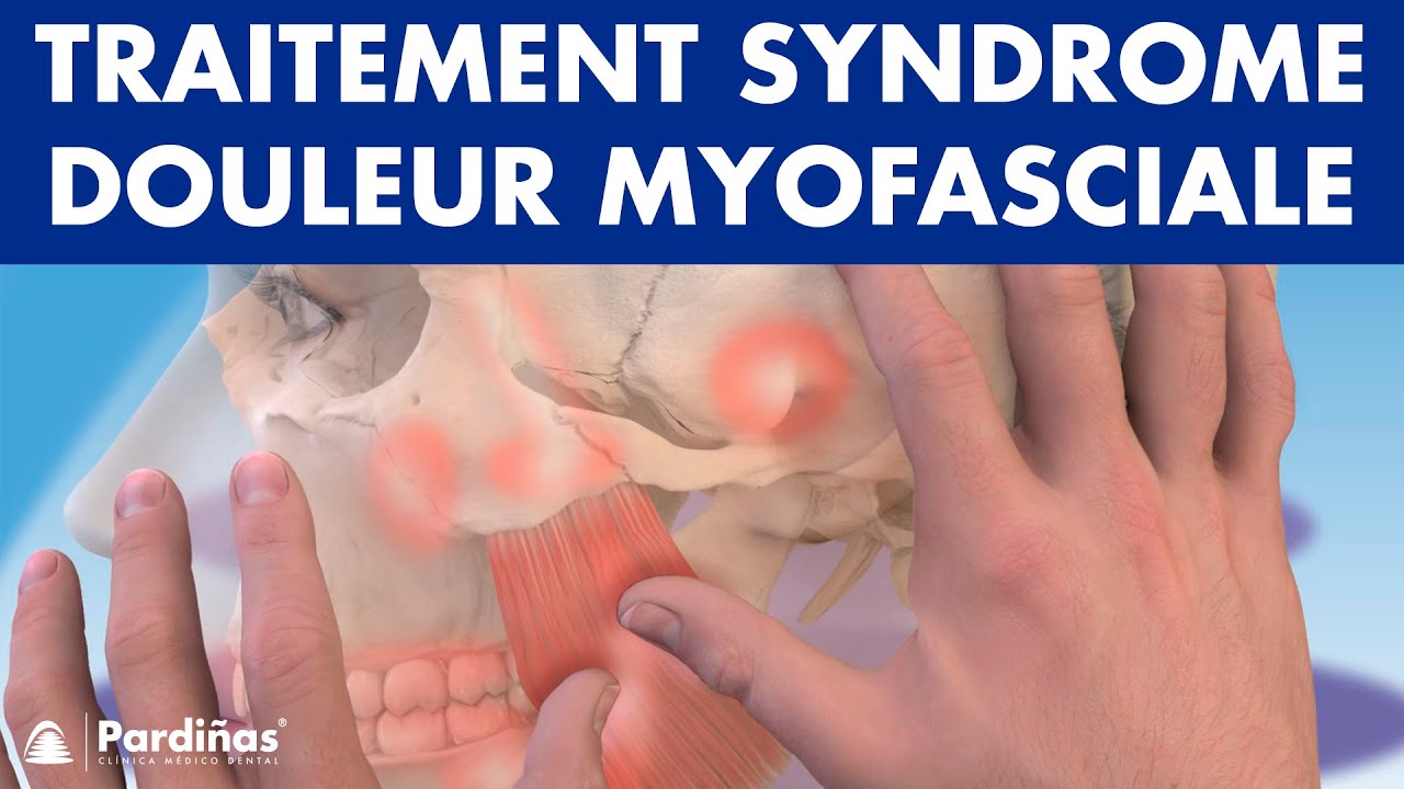 TRAITEMENT du Syndrome de DOULEUR MYOFASCIALE avec physiothérapie ©