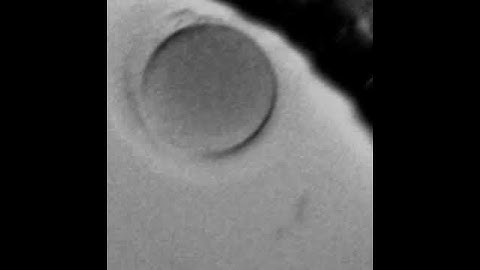 Multi PN zygote resulted in an euploid embryo.avi