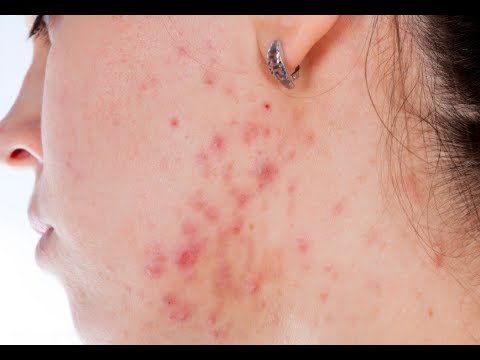 How to Stop Hormonal Acne - YouTube