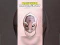Brain Tumor Removal Surgery |3D ANIMATIONS|#braintumorremoval #noninvasiveprocedure #fyp