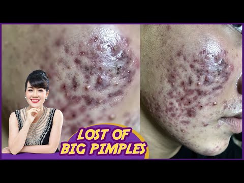 Video Lost of big pimples| Điều trị mụn hiệu quả số 1 TPHCM... - youtube
