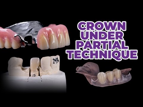 Crowns Under Partials Technique ?? - Dental Lab Tips & Tricks✏️