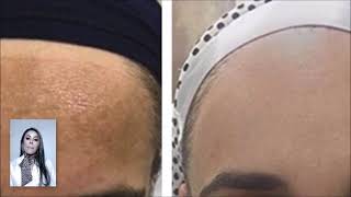 LAVIEEN LASER THULIUM 1927 NM BB LASER