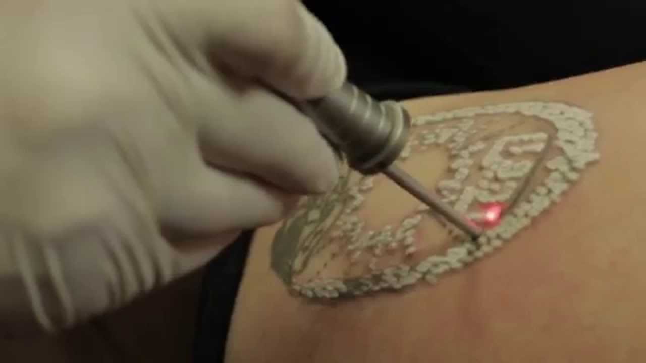 Laser Tattoo Removal in New Jersey  SOMA Skin  Laser