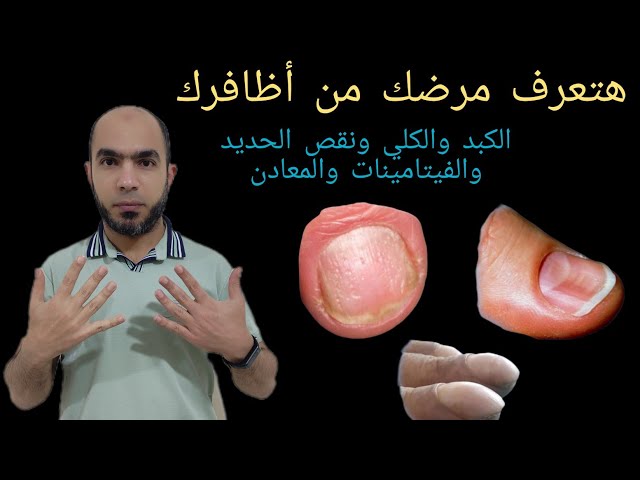 هل تعلم ما هي الأمراض التي يشير لها لون الأظافر هناك أمراض خطيرة youtube هل تعلم ما هي الأمراض التي يشير لها لون الأظافر هناك أمراض خطيرة youtube