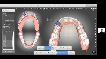 In Office Clear Aligner Seminar - Preview #2 Starting a Case