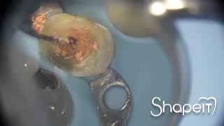 Rimozione della guttaperca in un ritrattamento endodontico. Dr. Andrea Balocco SHAPE IT