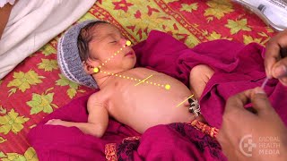 Inserting a Nasogastric Tube (Persian) - Small Baby Series