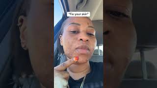Skin transformation #acne #cysticacne #skintransformation