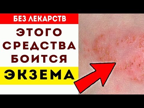 Как лечить экзему на ногах в домашних условиях фото