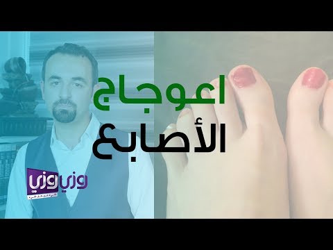 فيديو: لماذا تباعد أصابع قدمي؟