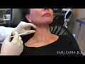 Treating Platysmal Banding With Botox Injections - Kami Parsa, M.D. in Beverly Hill