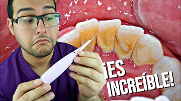 ¿Se puede eliminar el sarro de los dientes?