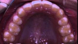 矯正治療例6　叢生（ガタガタ）　栃木県宇都宮市にある矯正歯科　くにい歯科・矯正歯科