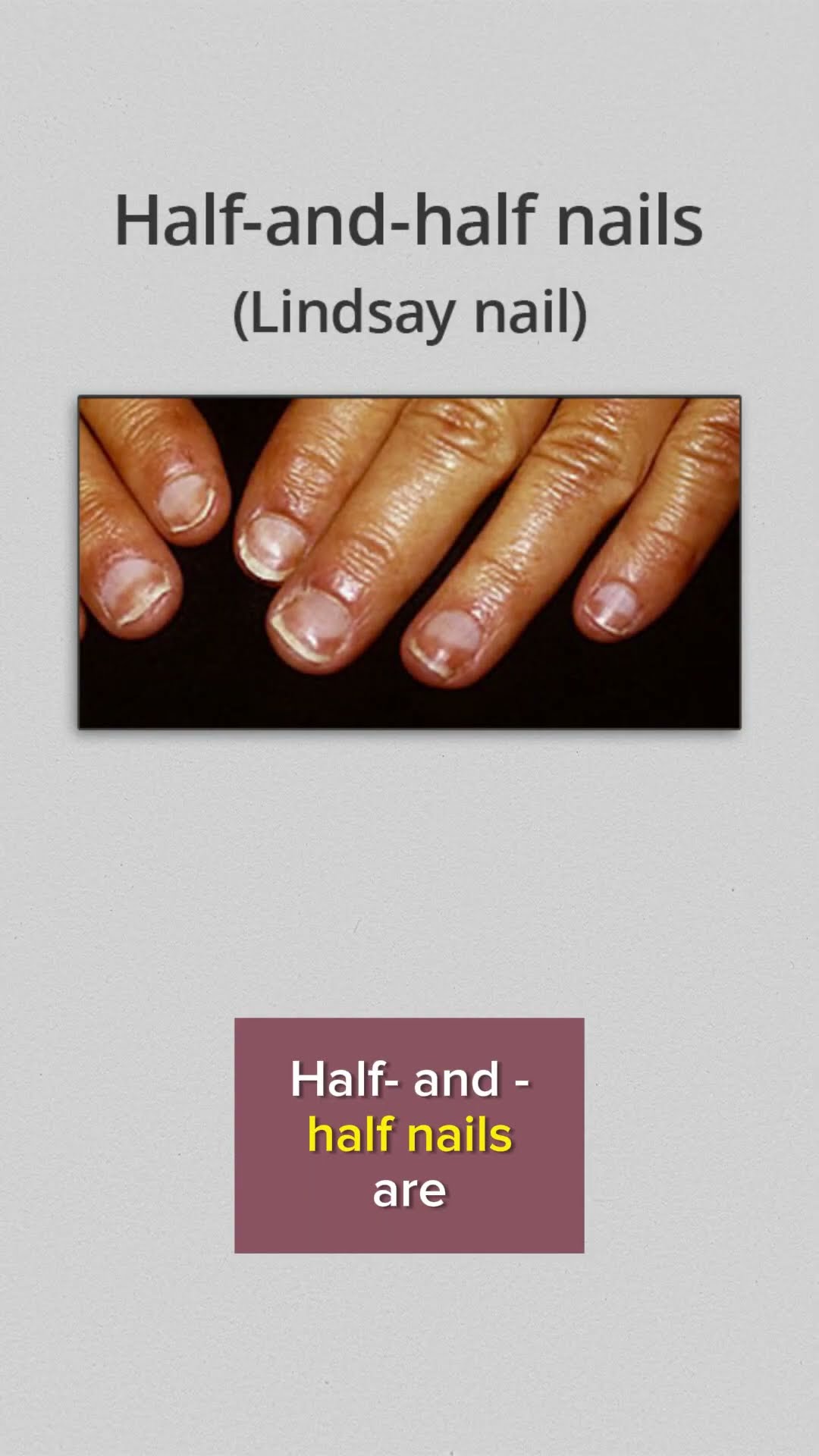 Fingernail changes in IBS, Gluten Sensitivity and Celiac Disease - Amy  Burkhart, MD, RD