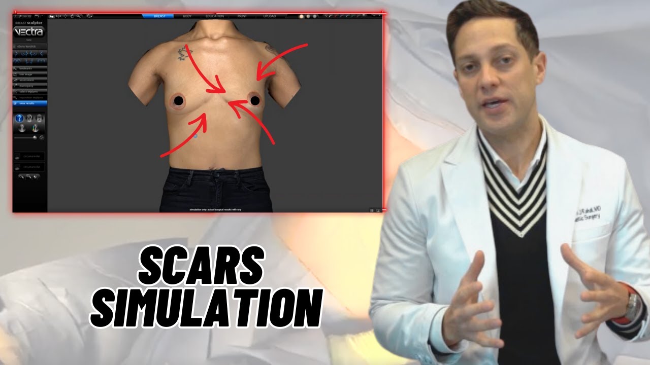 Breast Lift Types And Their Scars YouTube