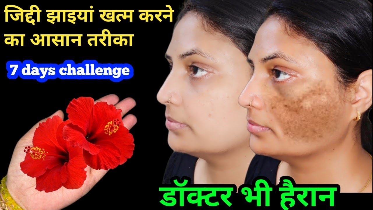 गुड़हल से झाइयां हटाने का कमाल का तरीका | Reduce Melasma, Pigmentation, Discolouration, Blackspots