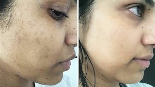 Fast acne and acne marks treatment|acne marks kese thek kre|sherag skin care|acne treatment at home