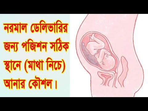 ভিডিও: ব্রীচ বাচ্চারা কি তাড়াতাড়ি আসে?