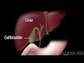 Gallstones and Surgical Removal of Gallbladder (Cholecystectomy) Animation.