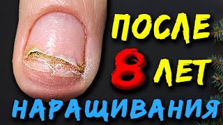 ОПАСНО!🚨 НОГТИ ОТПАЛИ. Вред НАРАЩИВАНИЯ! Спустя 8 лет.ОНИХОЛИЗИС.❌ Испортили Ногти.УЖАСНЫЙ МАНИКЮР