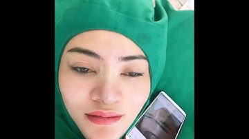 Cằm V line là gì? Phẫu thuật Độn Cằm V line được Vĩnh Viễn và đẹp ngày sau khi làm.