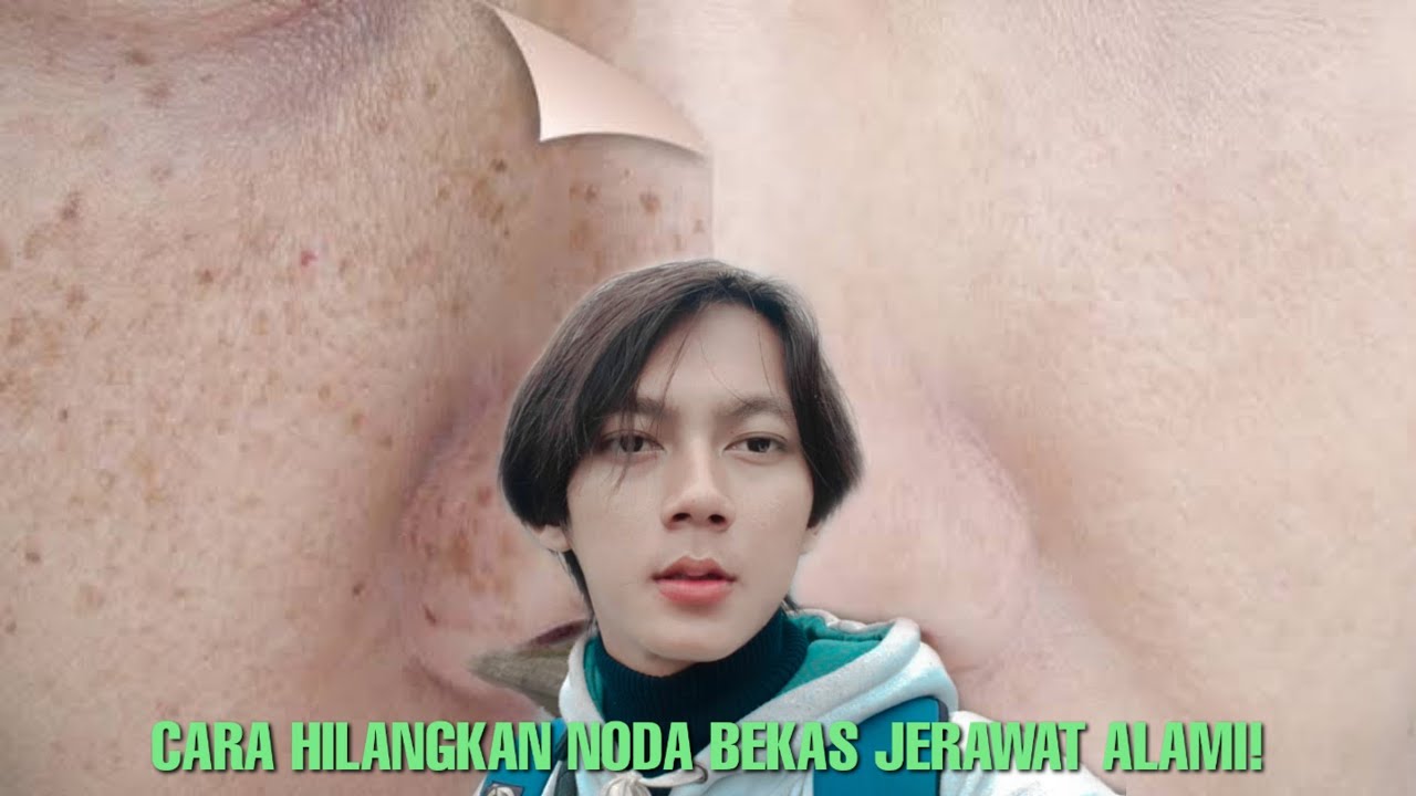 CARA HILANGKAN NODA HITAM BEKAS JERAWAT DI WAJAH? PAKE INI! 