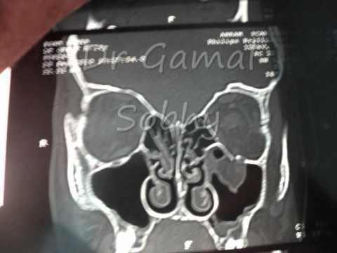   كسر عظام الحجاج