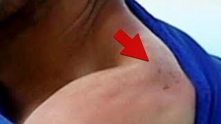Uruguayan Vampire Bites Again