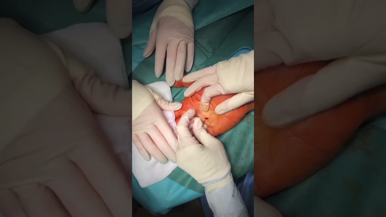 Video: Morbo di Dupuytren, trattamento percutaneo con ago