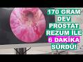 Rezum’un Sınırı Nerede? 170 Gram Prostata Rezum Tedavisi: Riskler ve Gerçekler