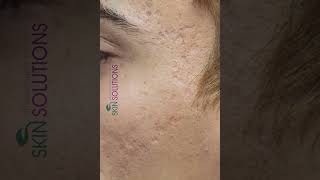 Acne Scar Removal: Clearer Skin | Real Results Before & Afte