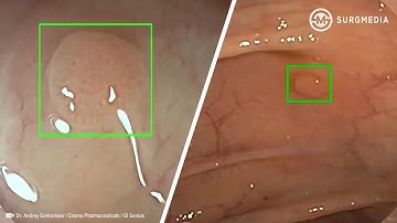 AI Guided Endoscopy System can spot any suspicious lesions and polyps even the smallest one.