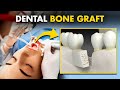 How Dental Bone Graft Surgery Is Performed? | Jaw Bone Graft Surgery