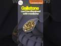 Kya Hota HainGallstones? Types Of Gallstones #gastrosurgeon #gallstone #surgery #digestivehealth