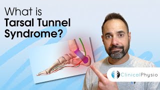 Tarsal Tunnel Syndrome | Expert Physio Guide