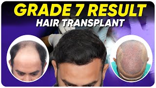Hair Transplant in Kolkata | Best Results & Cost of Hair Transplant in Kolkata