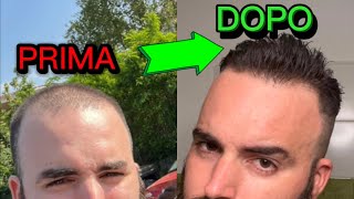 Caduta Capellitrattamento Calvizie Hairloss Treatment