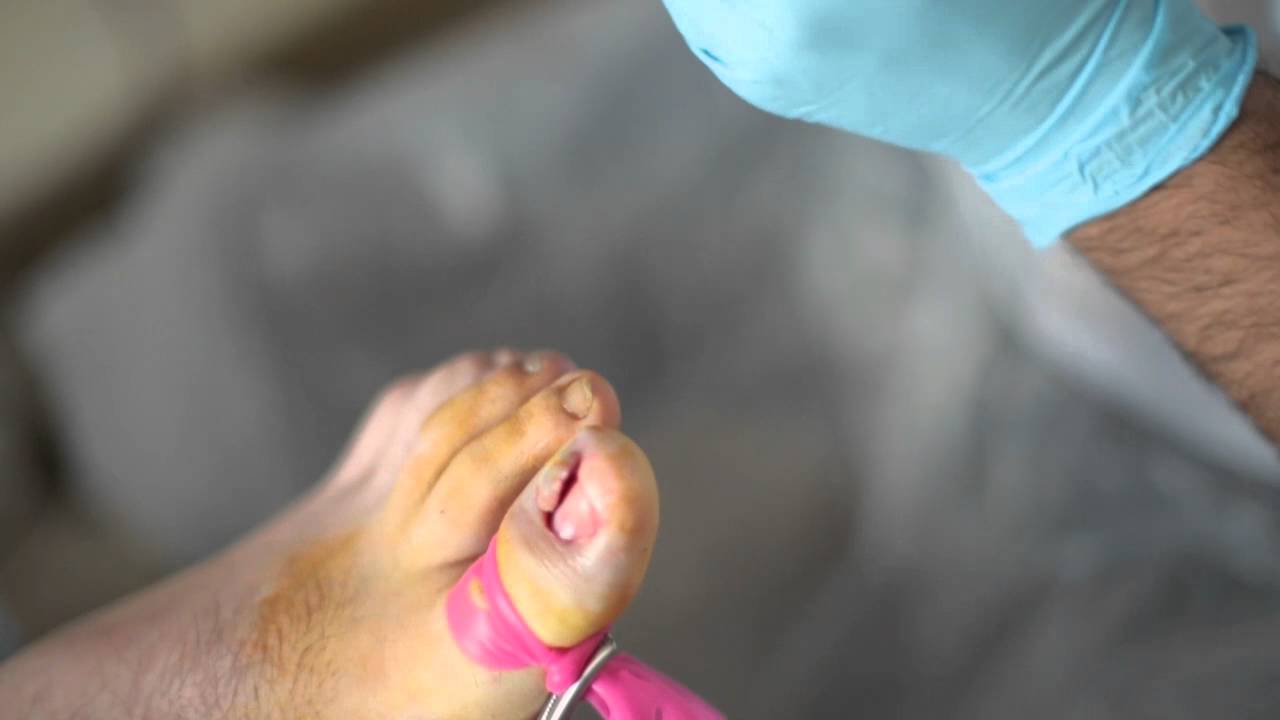 Ingrown Toenail Surgery - Council Bluffs Foot & Ankle Care, PC | Council  Bluffs, IA Podiatrist