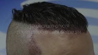 Пересадка волос в Турции 🇹🇷 2021 год | Результат до и после пересадки волос Hair translantation FUE