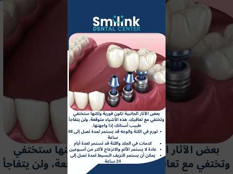 كيف تقلل مخاطر فشل زراعة الأسنان؟