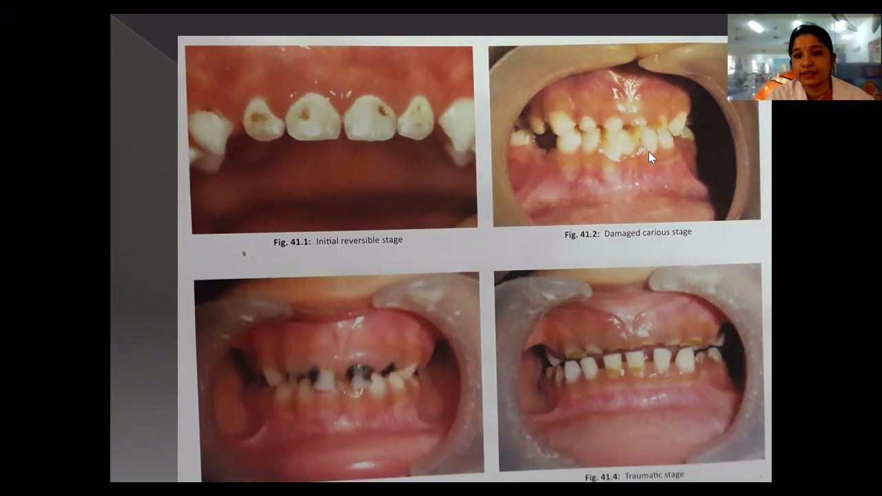 Early Childhood Caries