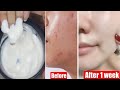 Korean Glow Facial |Dewy &amp;Anti Aging Skincare Routine |AM &amp; PM Skincare| Wrinkles Removal |Fair Skin
