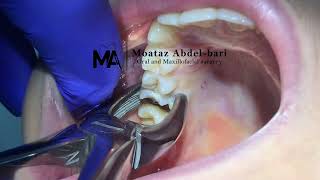 extraction of upper first molar using forceps