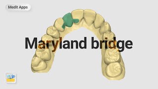 Designing a Maryland Bridge with the Medit Design App screenshot 2