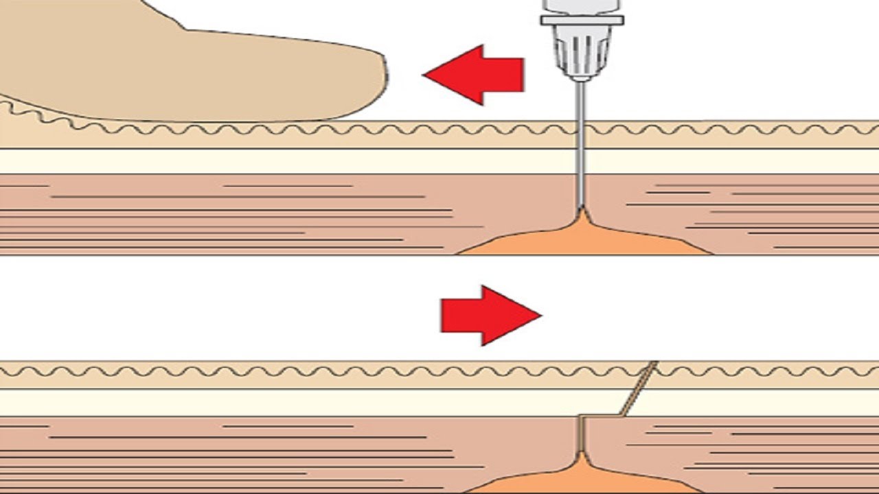 Укол внутримышечно в ногу самому себе видео