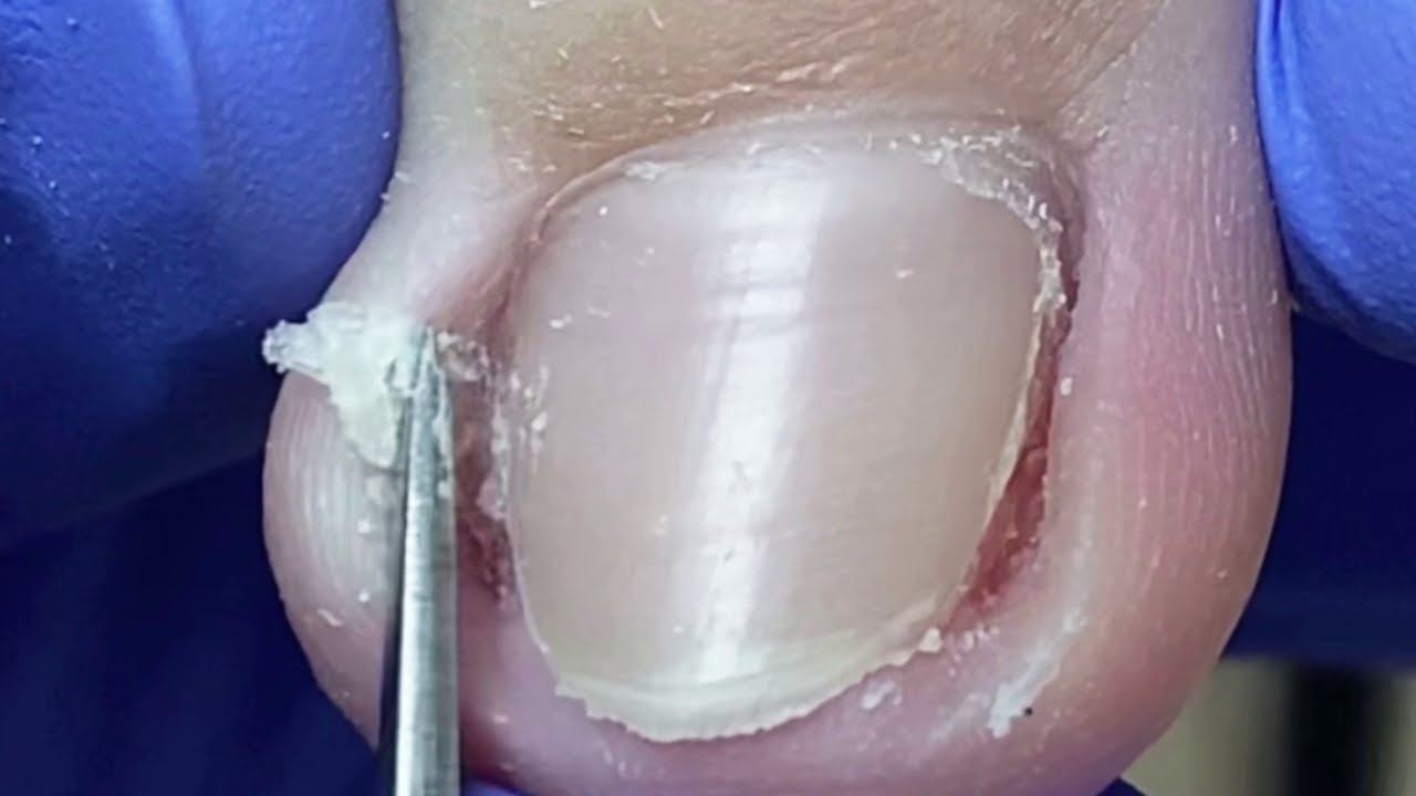 The nails are too long, the ingrown nails are too deep,it is too Liu