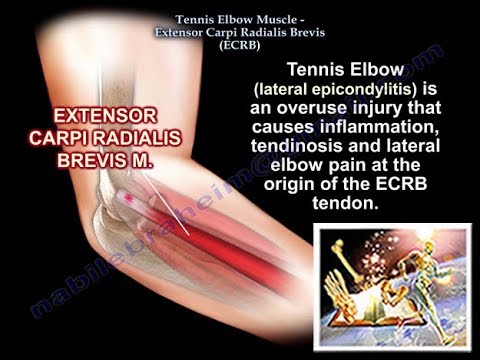 Tennis Elbow, Extensor Carpi Radialis Brevis, Everything You Need To Know - Dr. Nabil Ebraheim