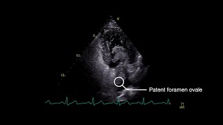 Stroke From Paradoxical Embolism Through a Patent Foramen Ovale