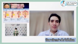 รักษาสิวอย่างไรให้ได้ผล Holistic acne Care หมอรุจชวนคุย